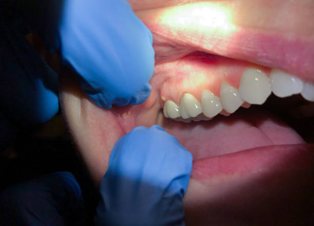 Best Emergency Denture Repair in Westwood Lakes, FL