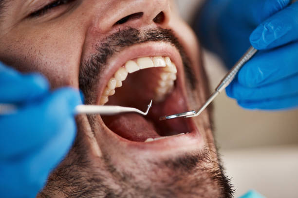 Best Emergency Wisdom Tooth Extraction in Westwood Lakes, FL